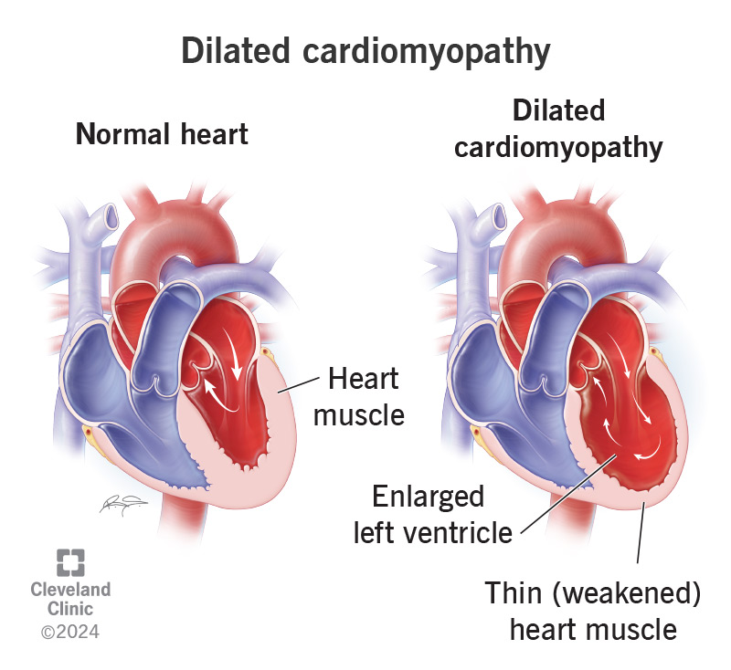 Image of a normal heart and a heart with Advanced Cardiomyopathy or Heart Failure.