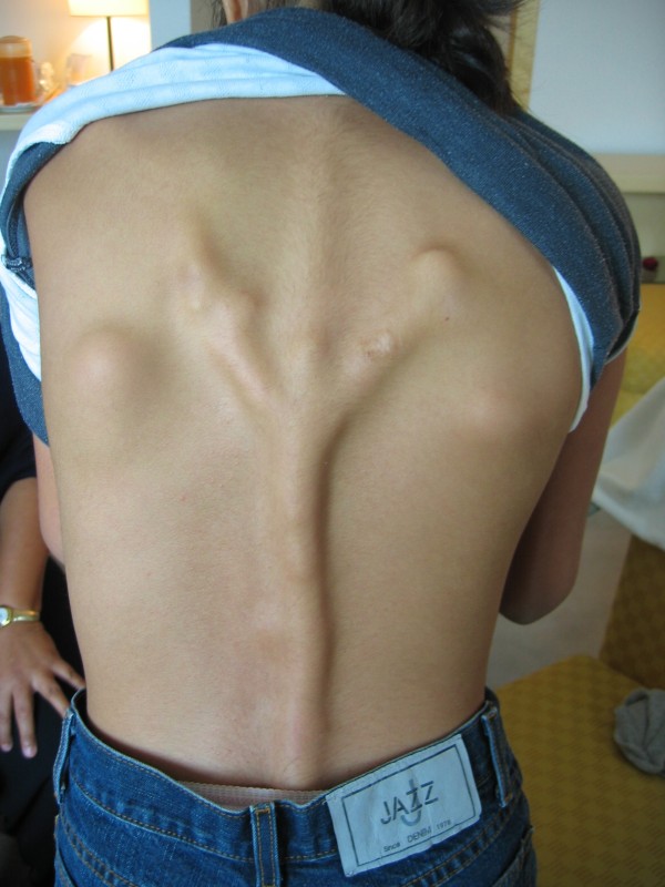 Fibrodysplasia Ossificans Progressiva