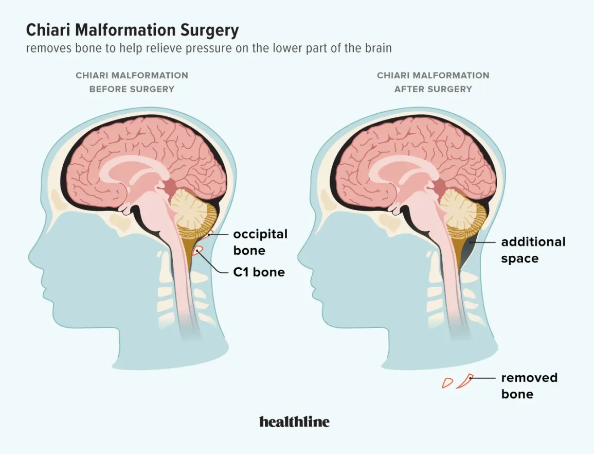 Chiari malformation