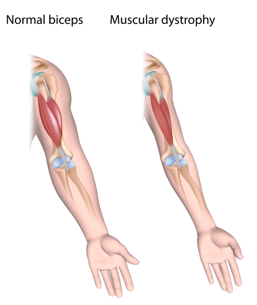 Muscular Dystrophy