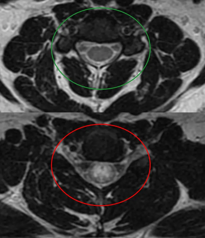 Transverse Myelitis