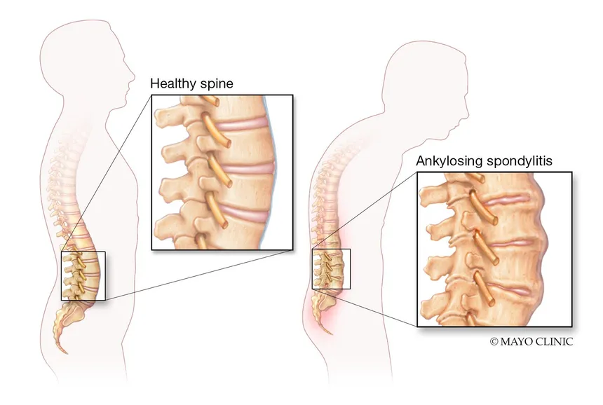 Ankylosing Spondylitis