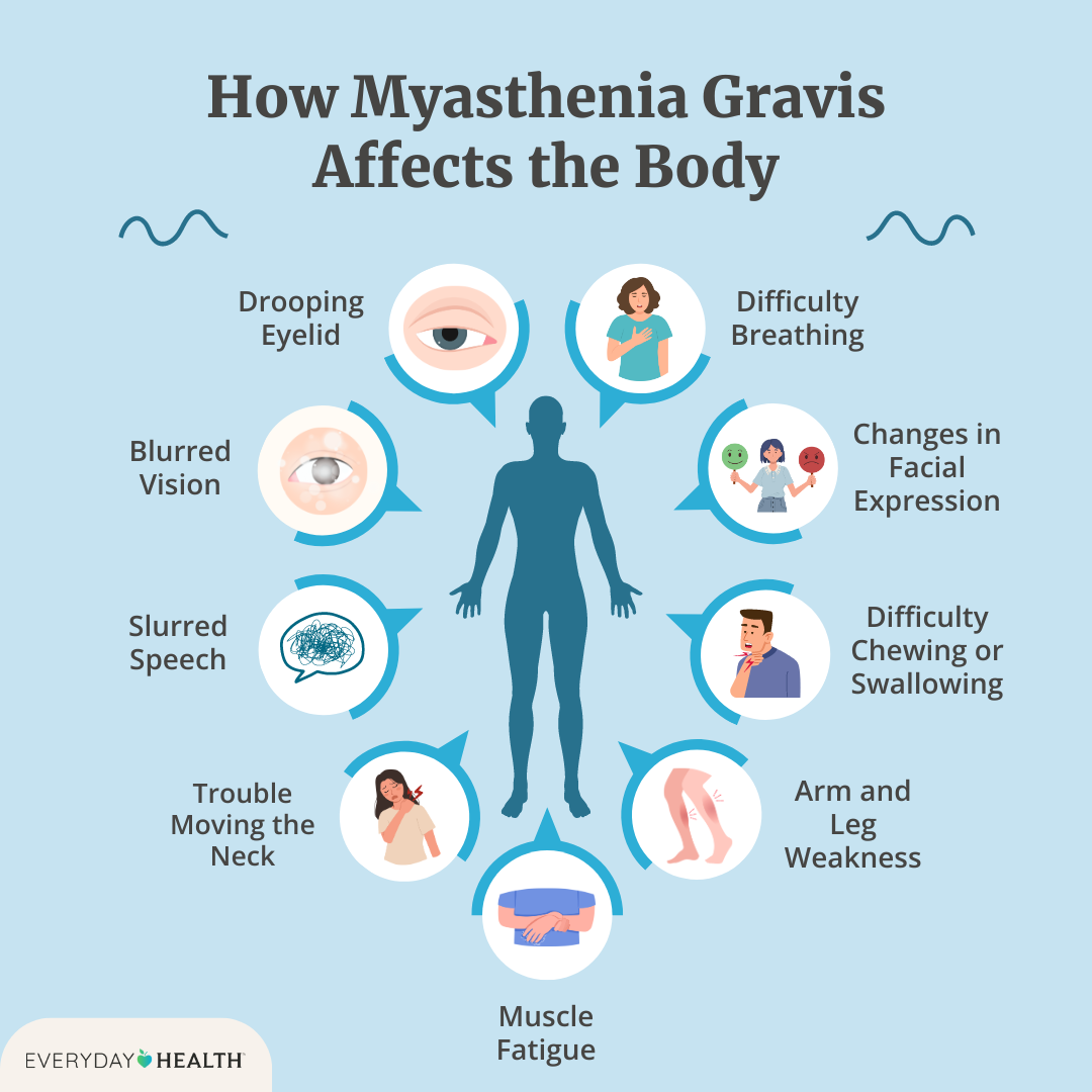 Myasthenia Gravis