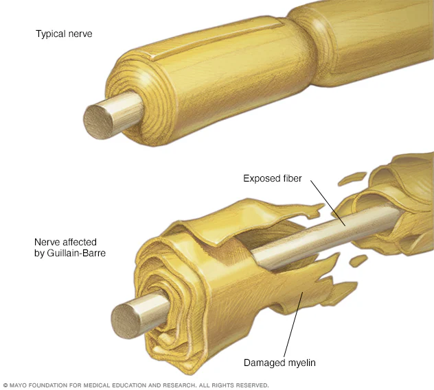 Normal nerve vs a nerve affected by Guillain-Barré Syndrome