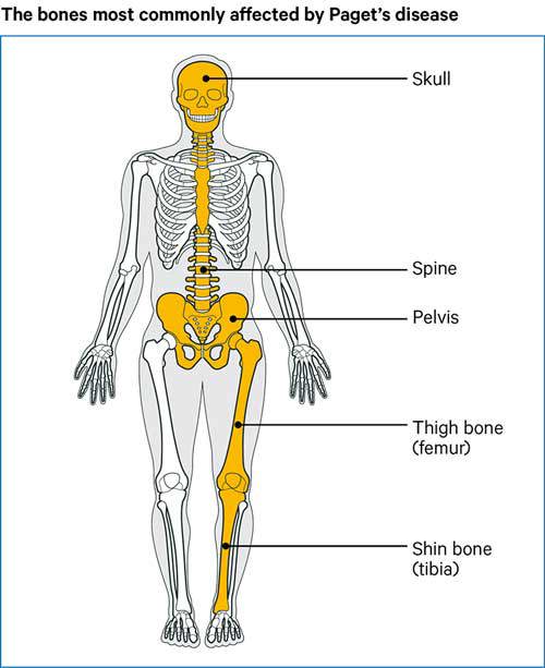 Paget’s Disease