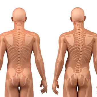 Severe Scoliosis and Kyphosis