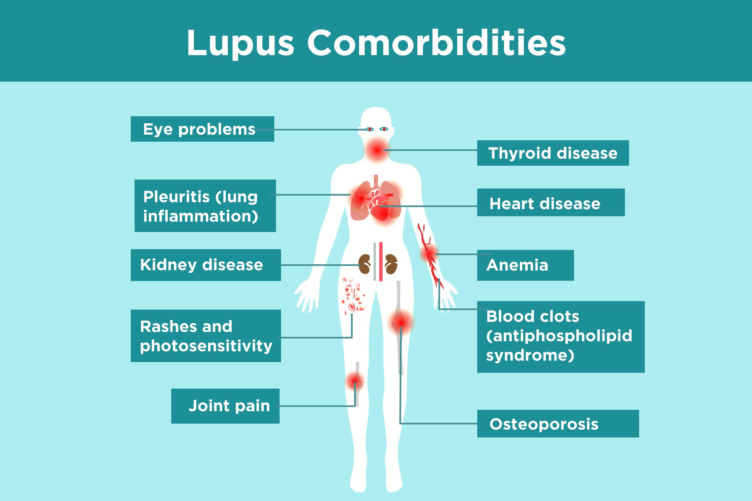 Lupus