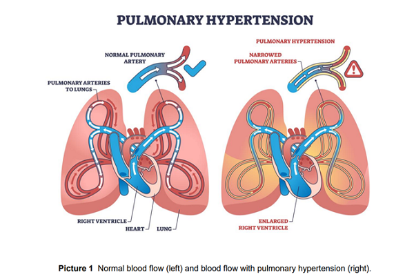 Pulmonary Hypertension