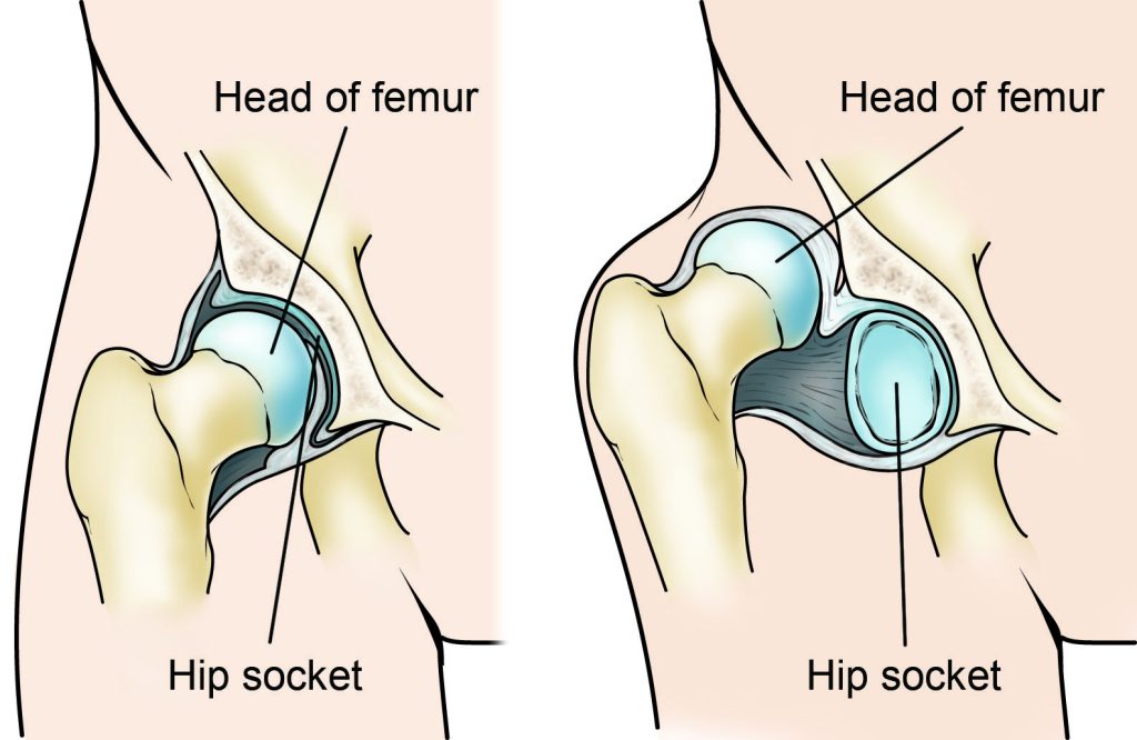 Congenital Hip Dysplasia