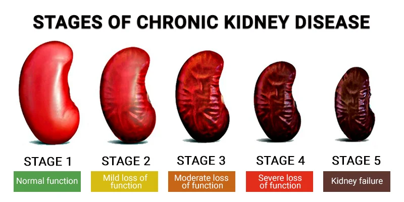 End-Stage Renal Disease (ESRD)