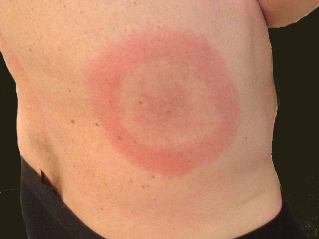 This pattern can appear with a Lyme Disease infection.