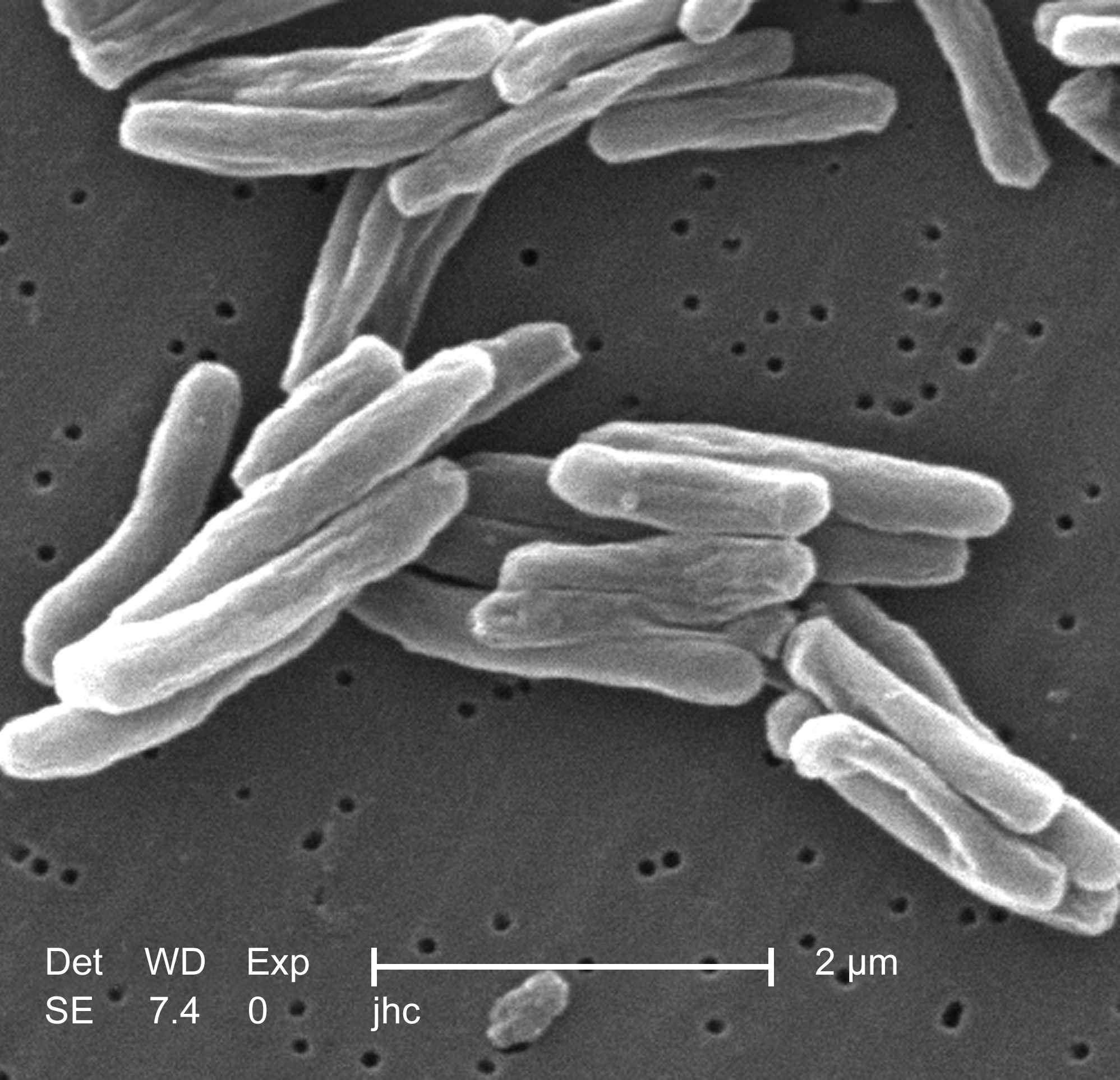 Tuberculosis affecting the spine (Pott’s Disease)